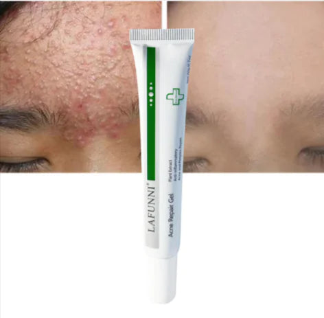 acne repair gel from ghg wellness shop